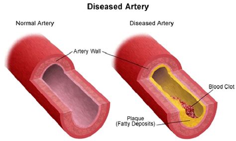 can be the result of a weakened blood vessel|Effects of Vascular Disease .